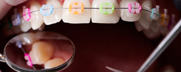 Appareils orthodontiques